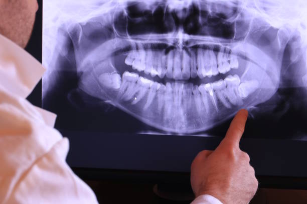 Best Emergency Wisdom Tooth Extraction in Lincoln Heights, OH